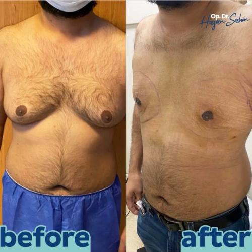 Liposucción Foto antes/después